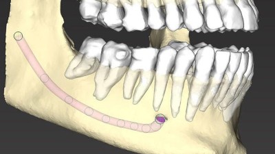Digitale Darstellung von Ober- und Unterkiefer mit der jeweiligen Dentition in weißen Farbschattierungen. Markierung des Verlaufs des N. alveolaris inferior (rosafarben)