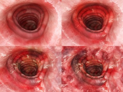 3D-Rendering aller Stufen der Colitis ulcerosa