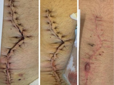  Oberflächliche Wundinfektion bei Z. n. Notfalllaparotomie bei Bridenileus