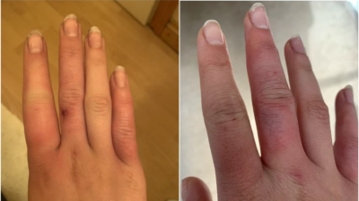 Photos of patients with hand chilblains and inflammatory arthritis