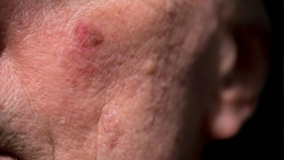 Aktinische Keratose
