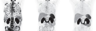 Radionuklidtherapie bei einem Patienten mit metastasierten kastrationsresistenten Prostatakarzinom 
