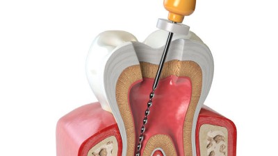 Illustration eines Zahns mit Wurzel im Querschnitt in Knochen. In Zahn und Wurzel ist eine endodontisches Instrument eingebracht.