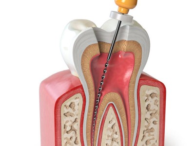 Illustration eines Zahns mit Wurzel im Querschnitt in Knochen. In Zahn und Wurzel ist eine endodontisches Instrument eingebracht.