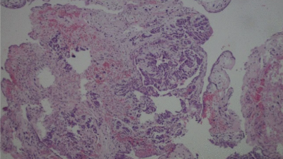 Photomicrograph of villiform cardiac myxoma with atypical glandular differentiation histology