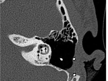  Computertomographie Felsenbein links 