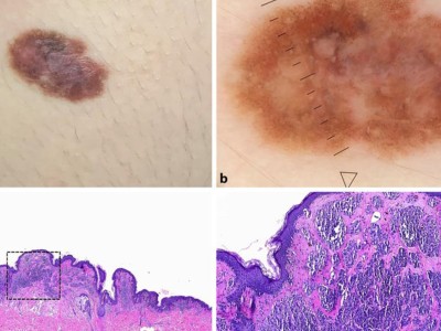 Springer Medizin Podcast - Neue Leitlinie Melanom