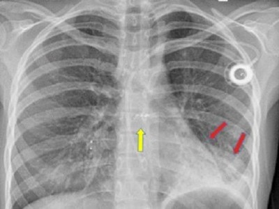 Bildgebung bei ambulant erworbener Pneumonie