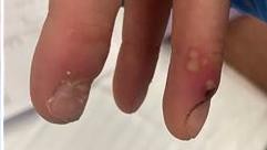 Herpes genitalis, Panaritium und Lymphangitis des Armes – HSV 1 als Missing Link