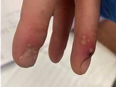 Herpes genitalis, Panaritium und Lymphangitis des Armes – HSV 1 als Missing Link