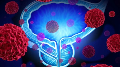 Prostate cancer illustration