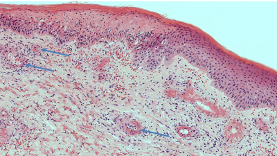 Patient with IgA vasculitis associated with chronic myelomonocytic leukemia
