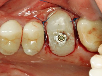 Eingesetztes healing Abutment bei Zahn 26 mit in der Kaufläche des Provisoriums sichtbarer Öffnung der Schraube. Links und rechts des Abutments sind frische Nähte zu sehen.