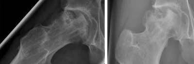 Hüftkopfnekrose eines 13-Jährigen 