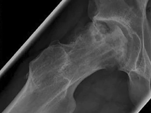 Hüftkopfnekrose eines 13-Jährigen 