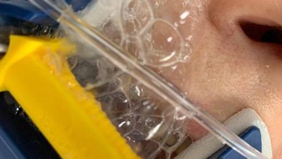Schaumiger Auswurf bei intubierter Patientin