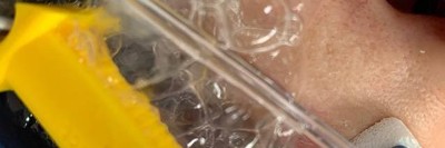 Schaumiger Auswurf bei intubierter Patientin