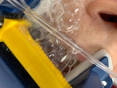 Schaumiger Auswurf bei intubierter Patientin