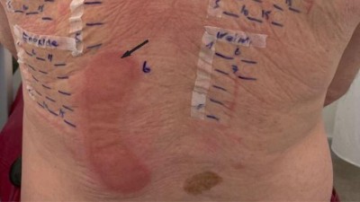 Epikutantest am Rücken