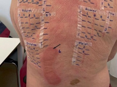Epikutantest am Rücken