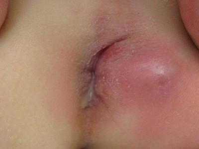 Perianaler Abszess bei einem Säugling mit Pus-Austritt aus dem Anus