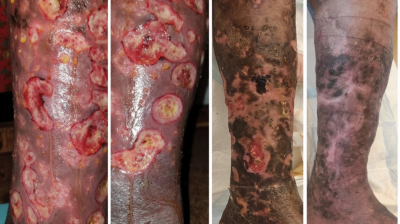 Photos of leg ulcers in patient with ulcerative cutaneous sarcoidosis