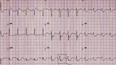 EKG mit J‑Welle