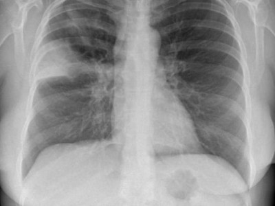 Fallbeispiel Röntgenaufnahme des Thorax in zwei Ebenen