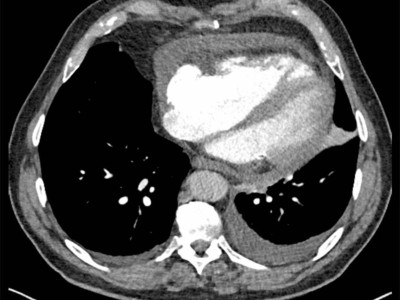 CT Thorax und Abdomen