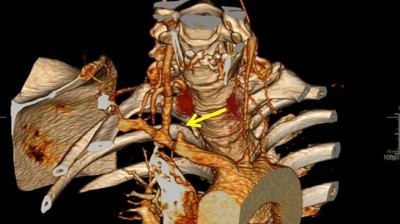 3D volume rendering showing ischemic occlusion in patient with Takayasu’s arteritis