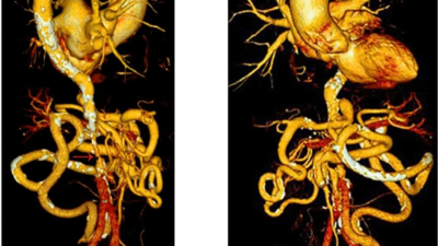 Thoracoabdominal computed tomography angiography