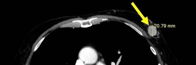 CT-Thorax mit dem gut 20 mm großen knotigen Herdbefund in der linken Brust (Pfeil)