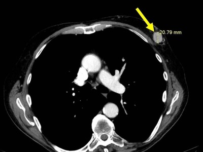 CT-Thorax mit dem gut 20 mm großen knotigen Herdbefund in der linken Brust (Pfeil)