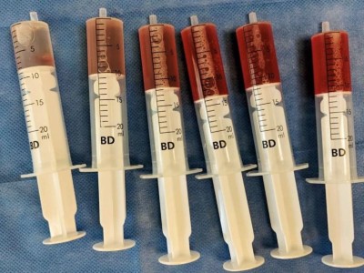 Bronchoalveoläre Lavage