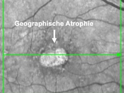 Geographische Atrophie
