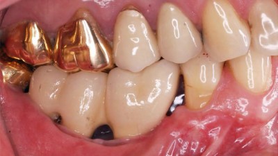 Seitenzahnbereich: Im Unterkiefer verblockt versorgte kurze Implantate bei großer Kronenhöhe. Entsprechend der Implantatposition (a) ausgeformte und mit der Zwischenraumbürste putzbare Interdentalräume sichtbar. Im Oberkiefer sind teilweise goldene Kronen sichtbar