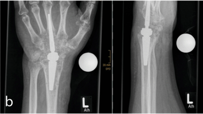 X-rays of patient with heterotopic ossification after wrist replacement