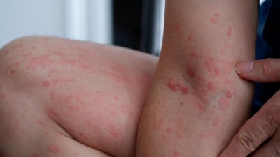 Hautausschlag auf Ellenbogen und Bein