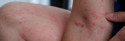 Hautausschlag auf Ellenbogen und Bein