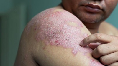 Image is a photograph of a man with psoriasis touching the bare skin on his arm