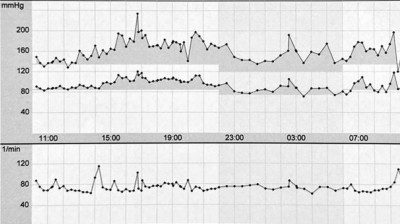 Langzeitblutdruckmessung bei Diabetiker