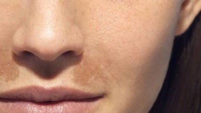Frau mit Hyperpigmentierung im Gesicht