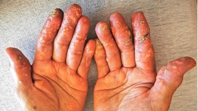 Multiple harte weißlich-gelbliche Knötchen an allen Fingern