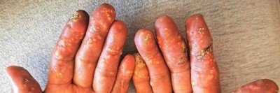 Multiple harte weißlich-gelbliche Knötchen an allen Fingern