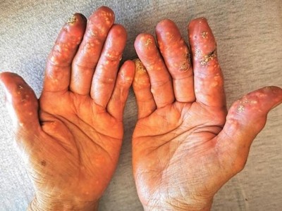 Multiple harte weißlich-gelbliche Knötchen an allen Fingern