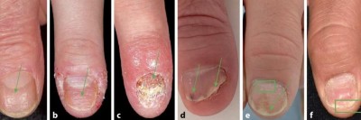  Klinische Zeichen der Nagelpsoriasis