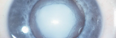 Kongenitale Katarakt