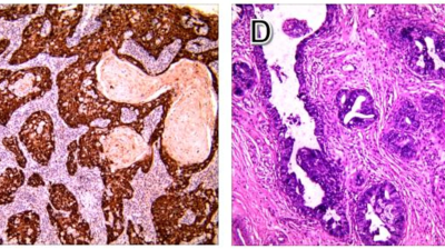 Immunohistochemistry showing cervical squamous cell carcinoma and adenocarcinoma from separate sites 