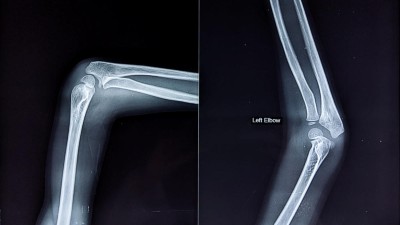 Leitthema: Bildgebung Schulter- und Ellenbogengelenk