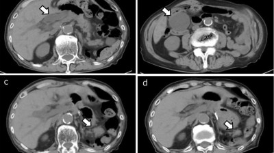 CT images suggestive of cholecystitis and cholangitis in a patient on pembrolizumab